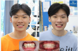 Học sinh, sinh viên niềng răng tại Ngân Phượng "hời" như thế nào?