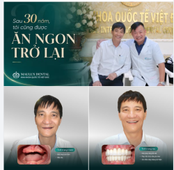 HƠN 30 NĂM MẤT RĂNG – CHÚ BÍCH CUỐI CÙNG ĐÃ CÓ THỂ ĂN UỐNG THOẢI MÁI