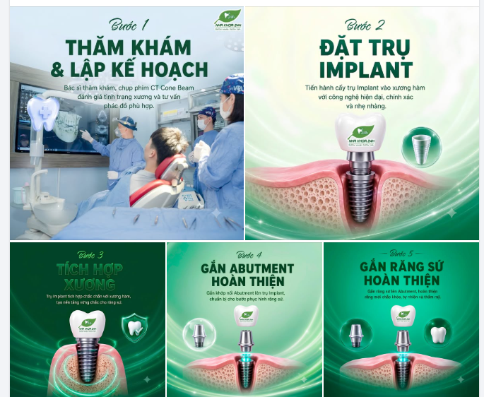 QUY TRÌNH TRỒNG RĂNG IMPLANT CHUẨN Y KHOA – TÌM LẠI NỤ CƯỜI CHẮC KHỎE NHƯ RĂNG THẬT