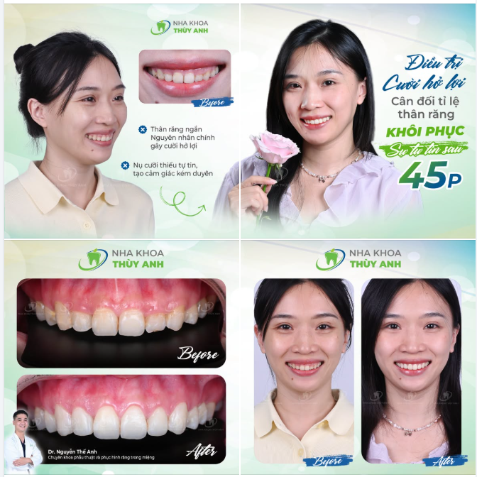 CƯỜI HỞ LỢI DO THÂN RĂNG NGẮN – CHỈNH TỶ LỆ NƯỚU ĐỂ NỤ CƯỜI RẠNG RỠ HƠN