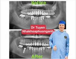 Vật liệu làm implant nha khoa từ gì? có an toàn không?