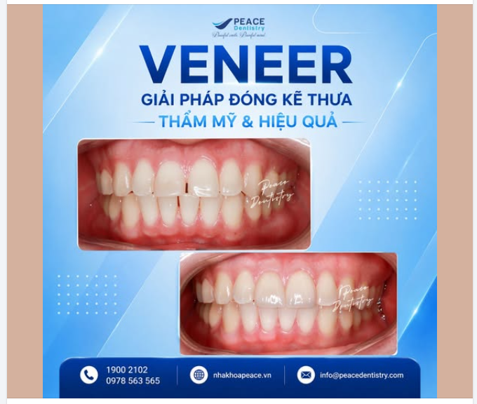 KHÔNG CÒN THƯA KẼ RĂNG CỬA - NỤ CƯỜI HÀI HÒA, RẠNG RỠ
