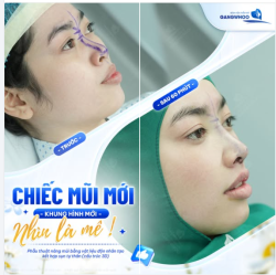 CHIẾC MŨI MỚI, DIỆN MẠO MỚI - NHÌN LÀ MÊ!