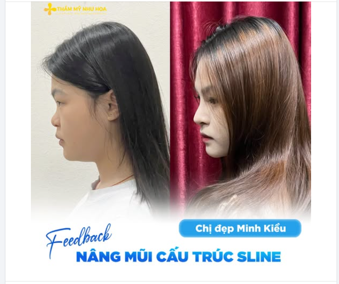Nâng mũi cấu trúc S-Line giúp chị đẹp Minh Kiều thay đổi đầy cuốn hút
