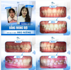 2 NĂM ĐEO NIỀNG VÀ THÀNH QUẢ ĐÁNG MONG ĐỢI