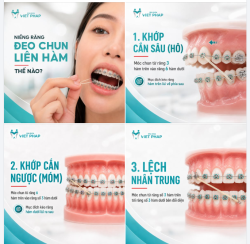 ĐEO CHUN LIÊN HÀM THẾ NÀO CHO ĐÚNG?