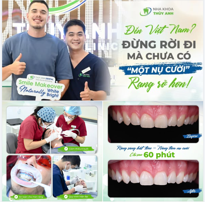 TẨY TRẮNG RĂNG LASER WHITENING  + 1 TRẢI NGHIỆM NÊN THÊM VÀO HÀNH TRÌNH KHÁM PHÁ VIỆT NAM