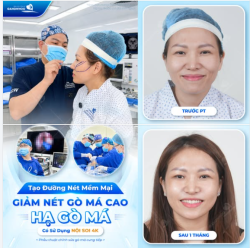 TẠO NÉT MẶT MỀM MẠI – GIẢM NÉT GÒ MÁ CAO - HẠ GÒ MÁ CÓ SỬ DỤNG NỘI SOI 4K