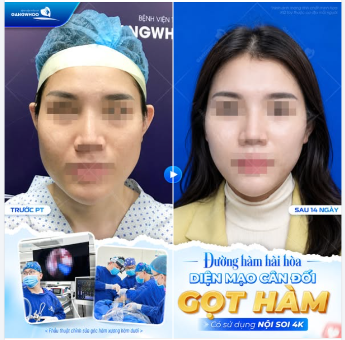ĐƯỜNG HÀM HÀI HÒA - DIỆN MẠO CÂN ĐỐI - GỌT HÀM CÓ SỬ DỤNG NỘI SOI 4K