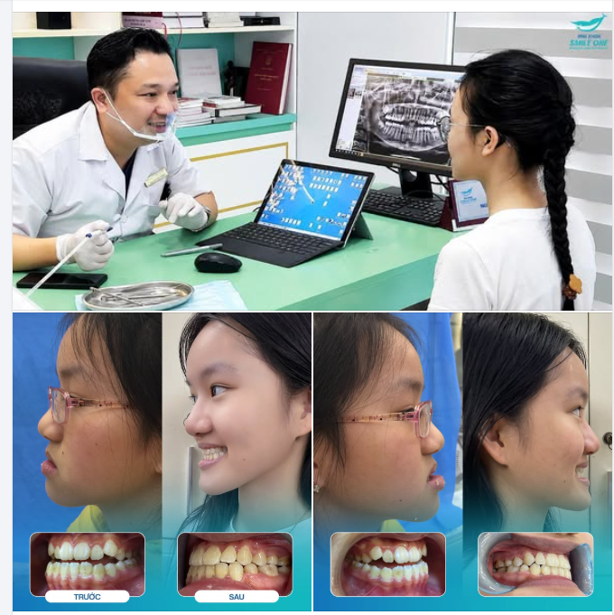 RĂNG MÓM NHẸ Ở TRẺ: ĐỪNG VỘI NGHĨ LỚN LÊN SẼ TỰ HẾT