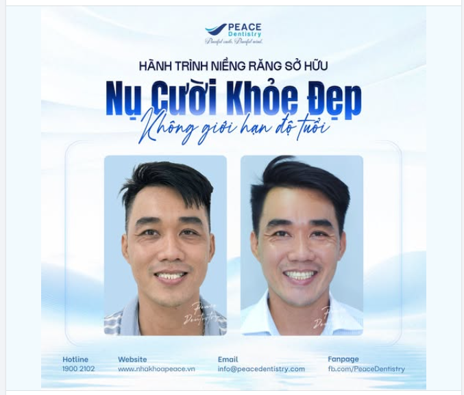 HÀNH TRÌNH SỞ HỮU NỤ CƯỜI RẠNG RỠ VỚI NIỀNG RĂNG CỦA KHÁCH HÀNG U40