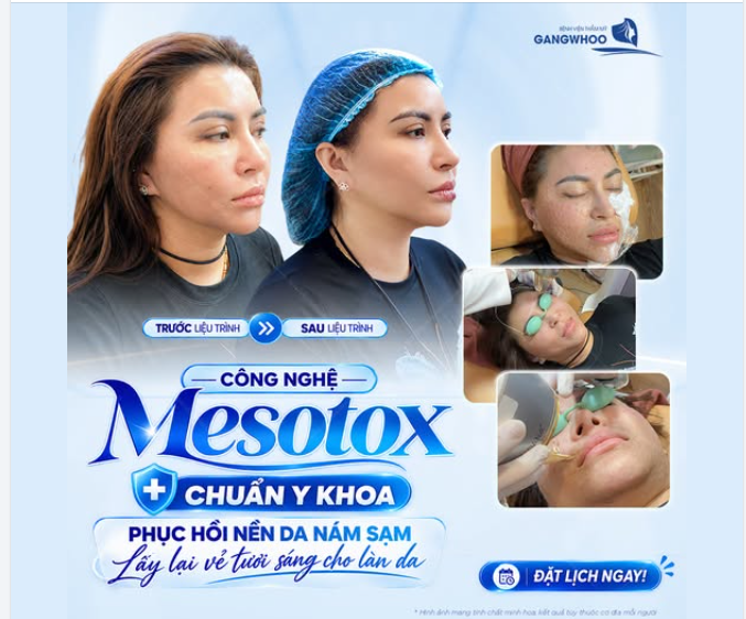 PHỤC HỒI NỀN DA NÁM SẠM NHỜ CÔNG NGHỆ MESOTOX