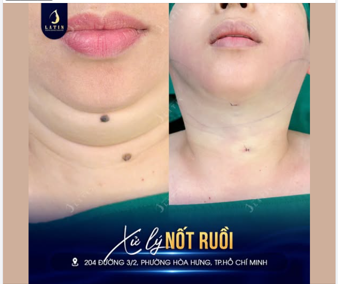 Với những nốt ruồi nằm ở vị trí dễ thấy, việc xử lý đúng điểm có thể giúp tổng thể gương mặt trông gọn mắt hơn mà không cần thay đổi quá nhiều.