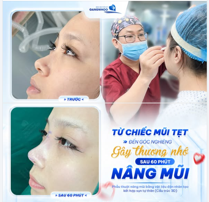 TỪ CHIẾC MŨI TẸT ĐẾN GÓC NGHIÊNG GÂY THƯƠNG NHỚ