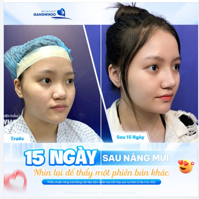15 NGÀY SAU NÂNG MŨI TẠI GANGWHOO