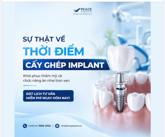 Cấy ghép Implant: Vì sao mỗi khách hàng cần một "lịch trình" riêng?