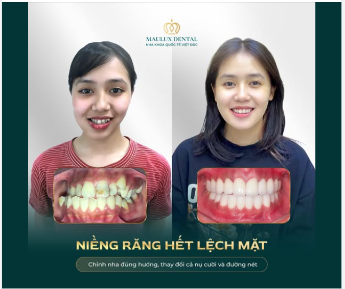 LỆCH KHỚP CẮN NẶNG, TRONG GIỚI HẠN PHẪU THUẬT - NIỀNG RĂNG CÓ THỂ THAY ĐỔI GƯƠNG MẶT ĐẾN ĐÂU?