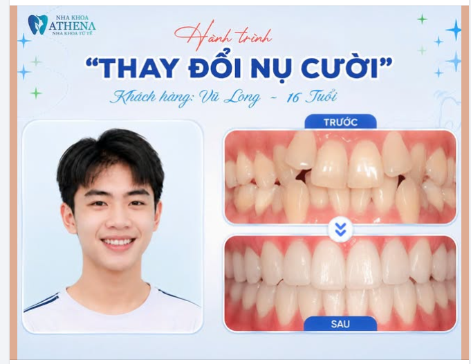 HÀNH TRÌNH "THAY ĐỔI NỤ CƯỜI" — Vũ Long, 16 tuổi