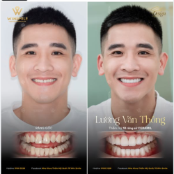 Với mong muốn kiến tạo lại một diện mạo hài hoà hơn, anh đã tin tưởng lựa chọn Win Smile. Qua đôi mắt thẩm mỹ của chuyên gia, nụ cười của anh đã khoác lên vẻ đẹp hoàn toàn mới: