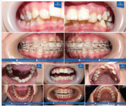 16 tuổi tháo niềng là cảm giác như thế nào?
