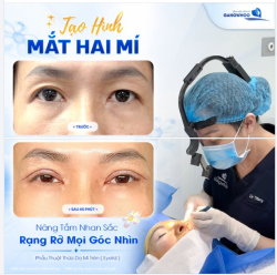 TẠO HÌNH MẮT HAI MÍ TẠI GANGWHOO