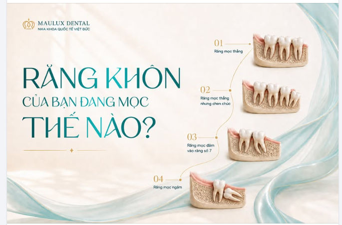 RĂNG KHÔN CỦA BẠN ĐANG MỌC KIỂU NÀO?