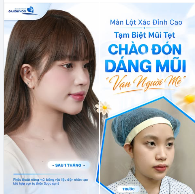 MÀN LỘT XÁC ĐỈNH CAO SAU KHI NÂNG MŨI