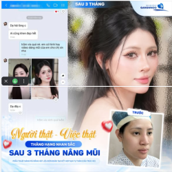 NGƯỜI THẬT - VIỆC THẬT: THĂNG HẠNG SAU 1 THÁNG NÂNG MŨI