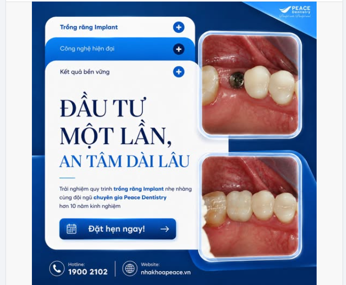 Trồng răng Implant cùng chuyên gia Peace Dentistry