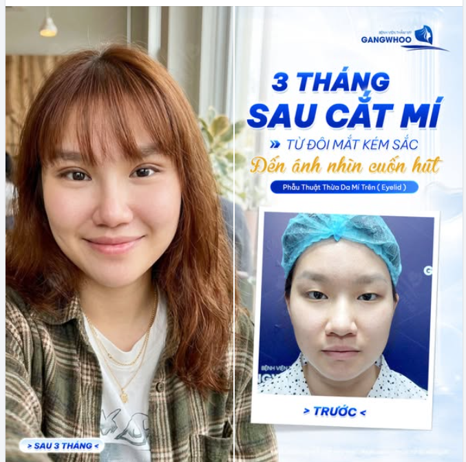KẾT QUẢ SAU 3 THÁNG CẮT MÍ EYELID