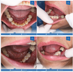 Hơn cả phục hình răng bị mất, implant mang tới