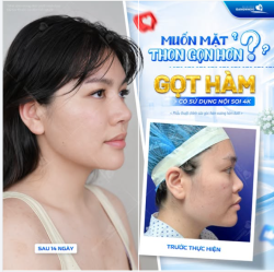 BẠN MUỐN HÀM THỌN GỌN? GIẢI PHÁP GỌT HÀM CÓ SỬ DỤNG NỘI SOI 4K