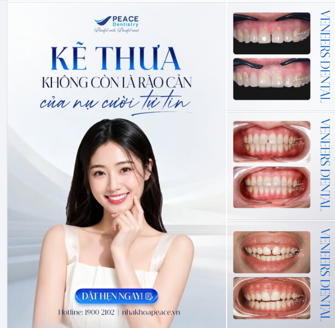 ĐỪNG ĐỂ KHOẢNG CÁCH NHỎ TRÊN RĂNG TRỞ THÀNH RÀO CẢN LỚN CHO SỰ TỰ TIN CỦA BẠN
