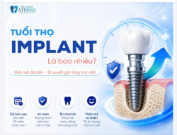 TUỔI THỌ IMPLANT LÀ BAO NHIÊU? GIẢI MÃ ĐỘ BỀN & BÍ QUYẾT GIỮ RĂNG TRỌN ĐỜI