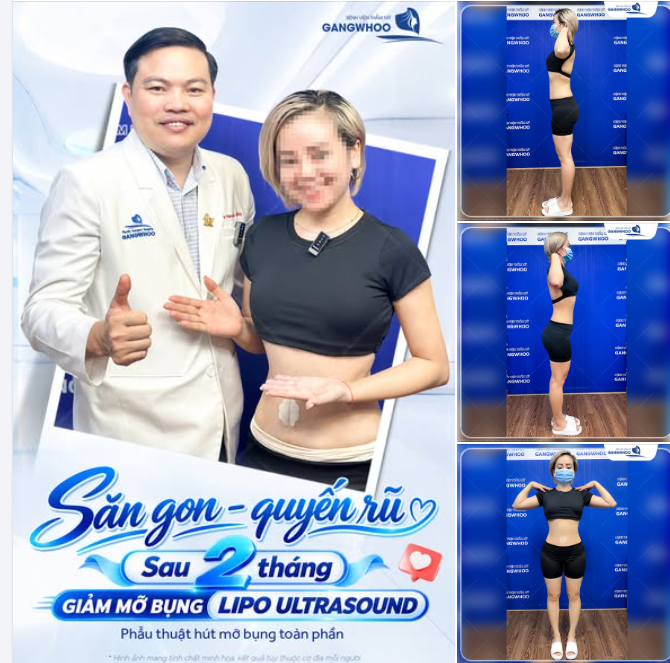 VÒNG EO THON GỌN - TỰ TIN TỎA SÁNG CÙNG LIPO ULTRASOUND