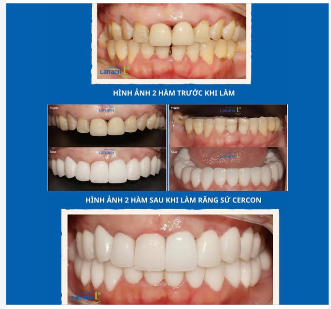 PHỤC HÌNH THÁO LẮP - GIẢI PHÁP PHỤC HỒI NỤ CƯỜI VÀ KHẢ NĂNG ĂN NHAI