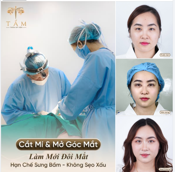 Cắt mí + Mở góc mắt trong sẽ thay đổi như thế nào?