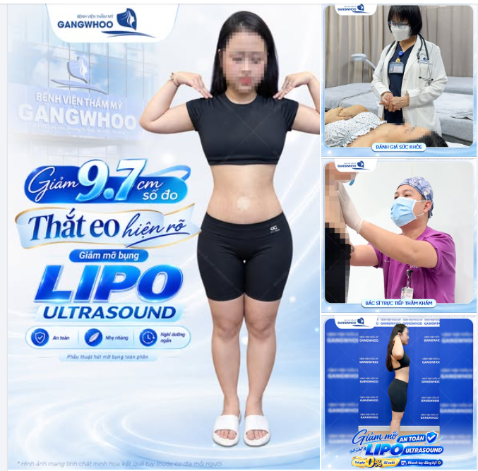 SÔ ĐO GIẢM, THẮT EO HIỆN RÕ  Sau giảm mỡ bụng Lipo Ultrasound