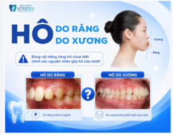 HÔ DO RĂNG HAY HÔ DO XƯƠNG? ĐỪNG VỘI NIỀNG KHI CHƯA RÕ NGUYÊN NHÂN!