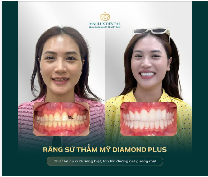 “GIỜ ĐÂY, TÔI CÓ THỂ CƯỜI THOẢI MÁI MÀ KHÔNG CẦN CHE MIỆNG NỮA…”