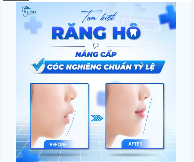 TẠM BIỆT RĂNG HÔ - NÂNG CẤP GÓC NGHIÊNG CHUẨN TỶ LỆ