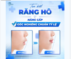 TẠM BIỆT RĂNG HÔ - NÂNG CẤP GÓC NGHIÊNG CHUẨN TỶ LỆ