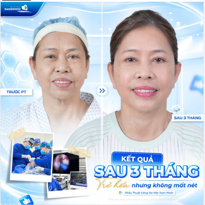 KẾT QUẢ SAU 3 THÁNG – TRẺ HÓA NHƯNG KHÔNG MẤT NÉT
