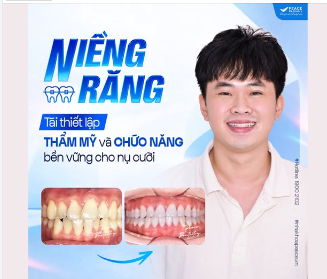 NIỀNG RĂNG KHÔNG CHỈ DỪNG LẠI Ở THẨM MỸ