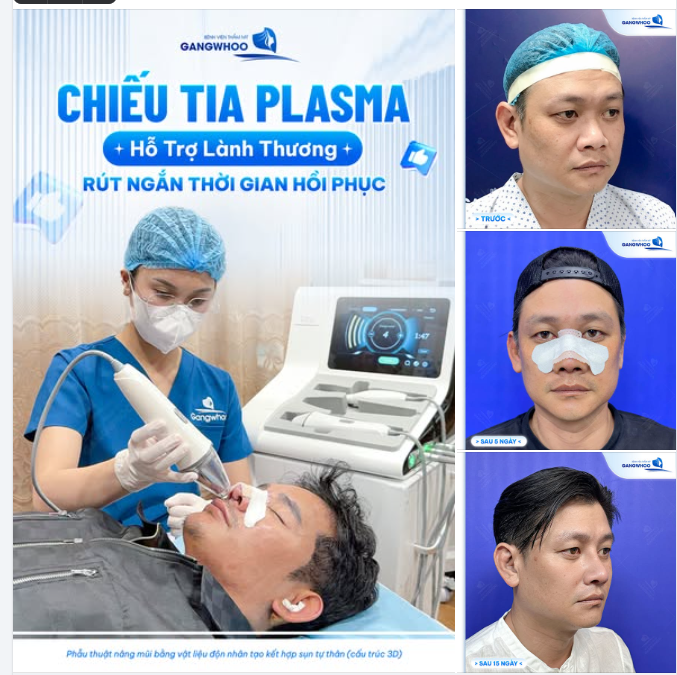 CHIẾU TIA PLASMA SAU KHI NÂNG MŨI