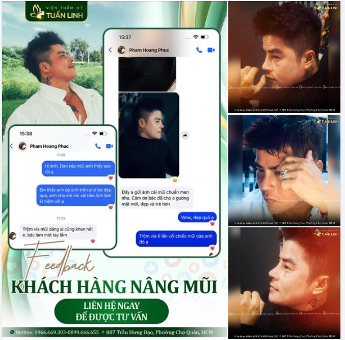 THÁO NẸP MŨI 10 NGÀY - NGỠ TRẺ RA 10 TUỔI