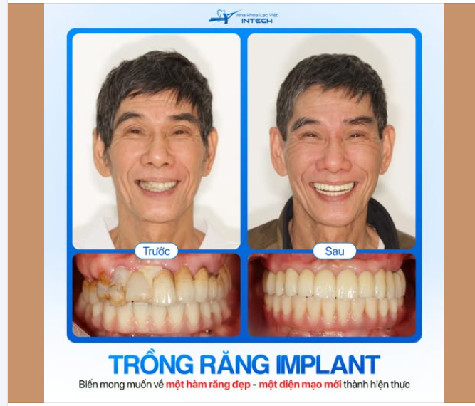 TRỒNG RĂNG IMPLANT - BIẾN MONG MUỐN VỀ MỘT HÀM RĂNG ĐẸP, MỘT DIỆN MẠO MỚI THÀNH HIỆN THỰC
