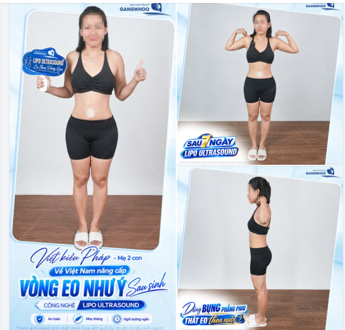 VIỆT KIỀU PHÁP NÂNG CẤP VÒNG EO NHƯ Ý SAU SINH