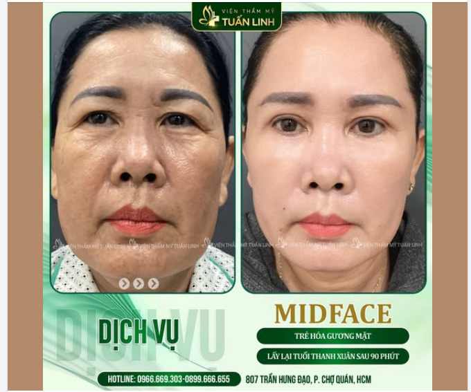 CĂNG DA MIDFACE – TRẺ HÓA LẤY LẠI THANH XUÂN
