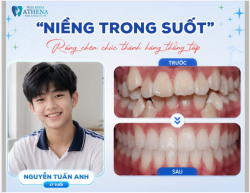 NIỀNG TRONG SUỐT – RĂNG CHEN CHÚC THÀNH HÀNG THẲNG TẮP CÙNG TUẤN ANH (17 TUỔI)